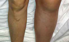 optivein_services_treatments_leg_swelling