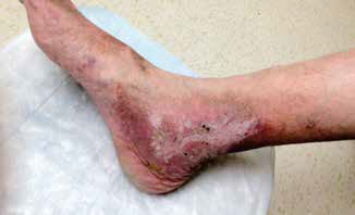 optivein_services_treatments_leg_wounds