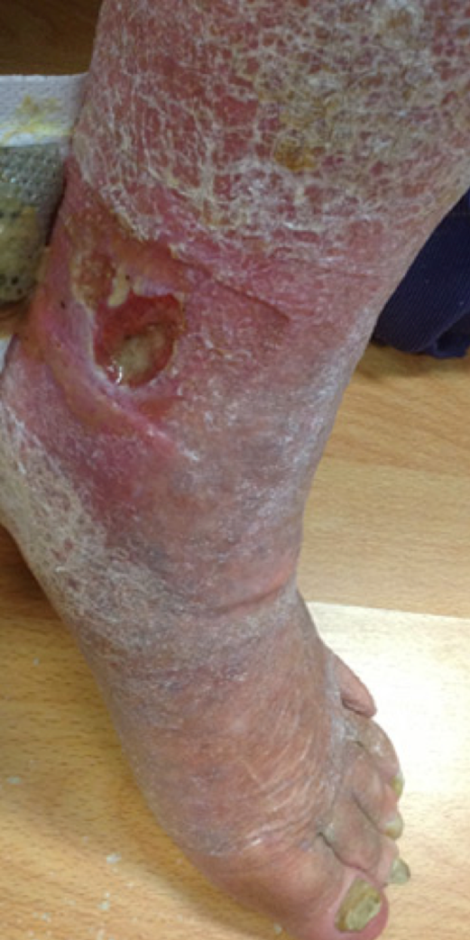 optivein_services_treatments_leg_wounds_before