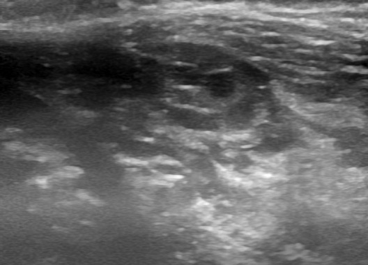 optivein_services_treatments_vascular_malformations_ultrasound