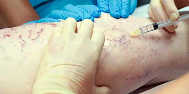 optivein_treatments_spider_veins_injection_sclerotherapy